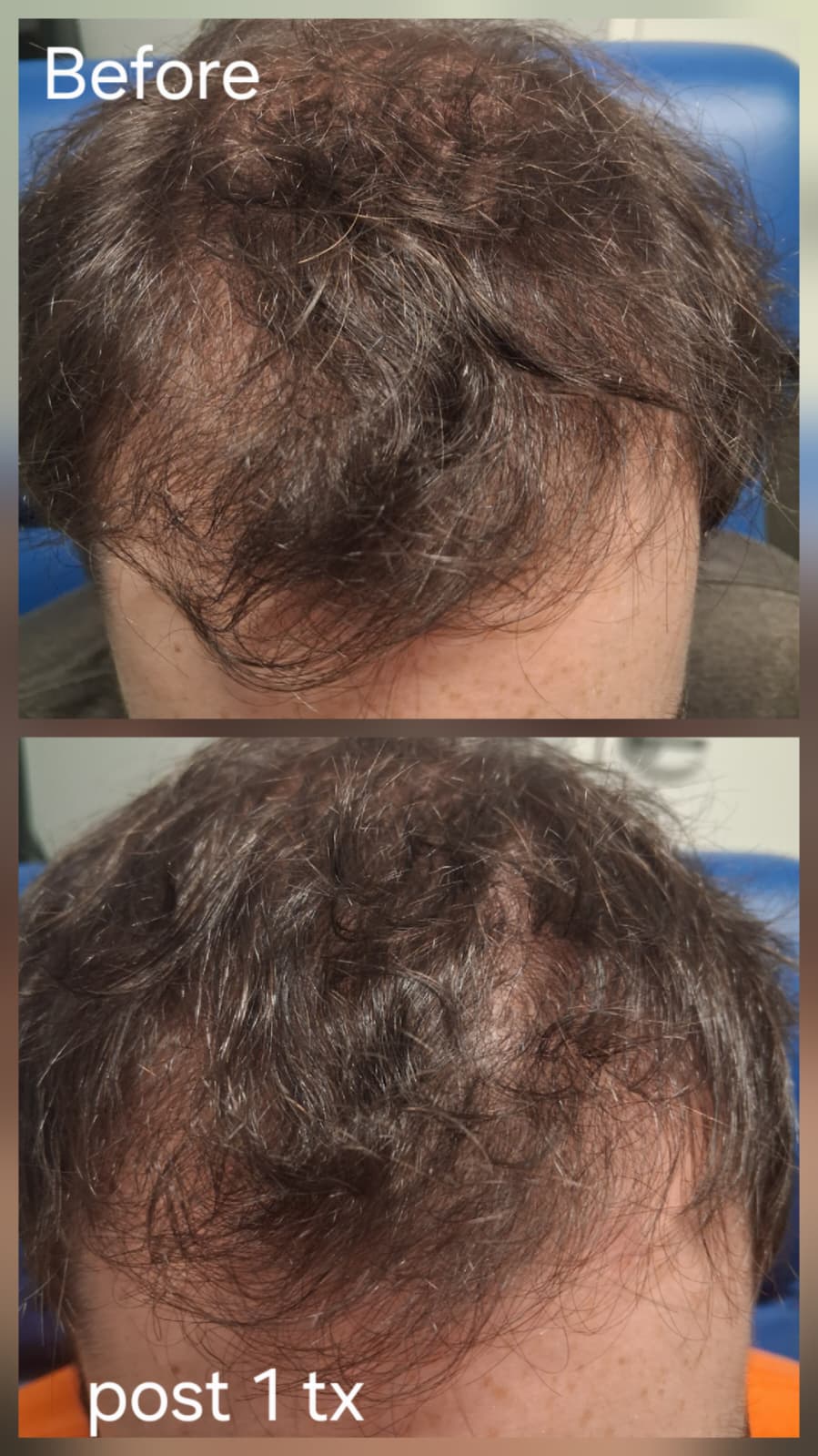 Hair restoration result